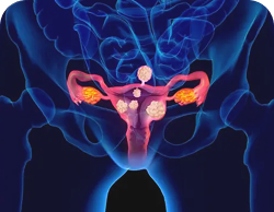 Fibroids Image
